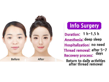korea-rhinoplasty-surgery-info