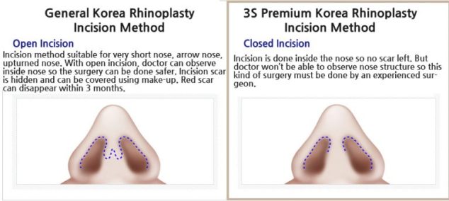 open-incision-vs-closed-incision